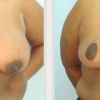 Virginia Beach Breast Reduction, Dr. Thomas Hubbard 4