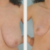 Virginia Beach Breast Reduction, Dr. Thomas Hubbard 5