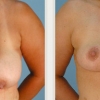 Virginia Beach Breast Reduction, Dr. Thomas Hubbard 6