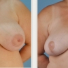 Virginia Beach Breast Reduction, Dr. Thomas Hubbard 9