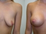 Dr. Michael Hueneke: Nashville Breast Lifts