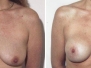 Dr. Elliot Jacobs: New York Breast Lifts