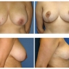 Beverly HIlls Breast Reduction, Dr. Vishal Kapoor 2