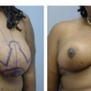Ormond Beach Breast Reduction, Dr. Carl Lentz 7