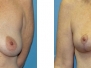 Dr. Loverme: Before and After Breast Lift