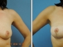 Dr. Ellen Mahony: Breast Lifts