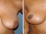Dr. Marc Malek: Breast Lift Photos