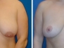 Dr. Eric Mariotti, Concord Breast Lifts