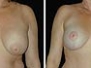 Dr. Craig Mezrow, Philadelphia Breast Lifts