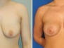 Dr. Mathew Mosher, Vancouver Breast Lifts