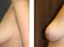 New York Group for Plastic Surgery: Breast Lifts
