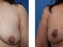 Dr. Yale Popowich: Portland Breast Lifts
