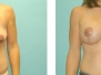 Dr. Jeffrey Poulter, Bloomington Peoria Breast Lifts