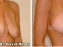 Dr. David Reath, Knoxville Breast Lifts
