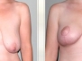 Dr. Paul Rhee: Breast Lifts