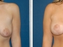 Dr. James Romanelli, Long Island Breast Lifts