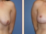 Santa Rosa Breast Lifts