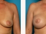 Sarasota Breast Augmentation and Lifts Photos