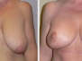 Dr. Bivik Shah: Columbus Breast Lifts