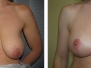 Dr. Howard Silverman, Ottawa Breast Lifts