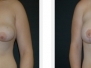 Dr. Andrew Smith: Before and After Breast Lifts
