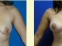 Dr. Chad Tattini, Bloomington Breast Lifts