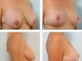 Dr. Vitenas: Houston Breast Lifts