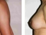 Dr. Michael Weinberg, Mississauga Breast Lifts